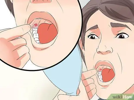 Tell if Your Wisdom Teeth Are Coming in Step 3