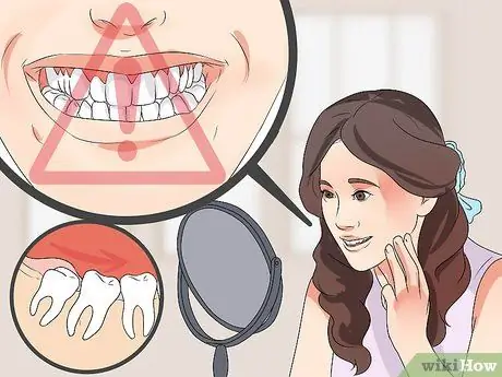 Tell if Your Wisdom Teeth Are Coming in Step 5