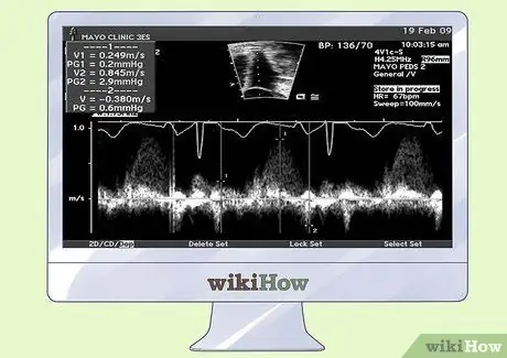 Interpretar els ecocardiogrames Pas 1