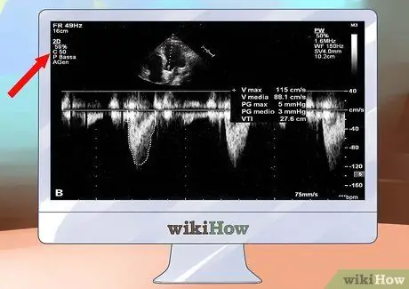 Interpretar els ecocardiogrames Pas 2