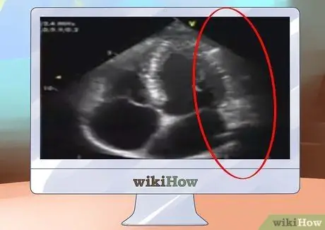 Txhais Echocardiograms Kauj Ruam 3