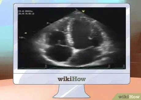 Etapa 4 da interpretação dos ecocardiogramas