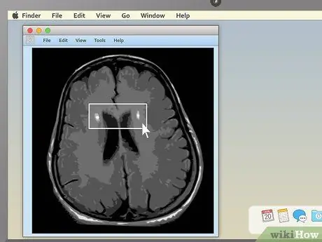 Pročitajte MRI korak 13