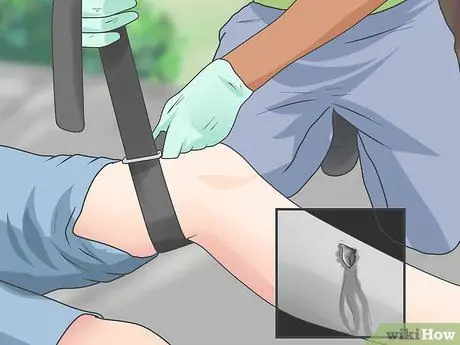 Tell if a Fall Broke Bones Without an X Ray Step 10