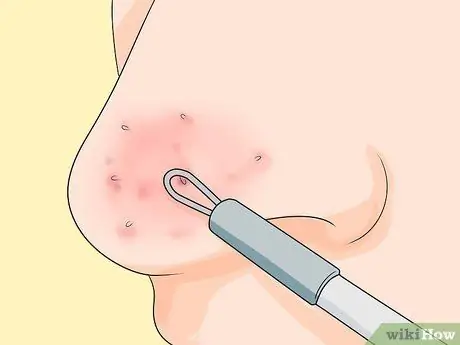 Pigilan ang Mga Blackhead Hakbang 10