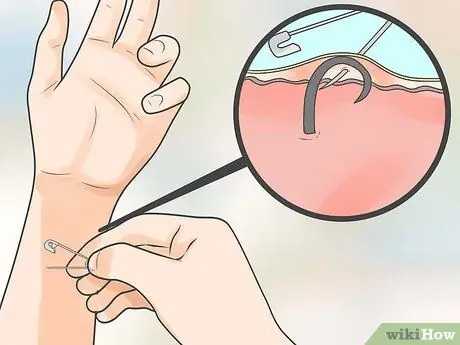 Remove an Ingrown Hair Under the Skin Step 8