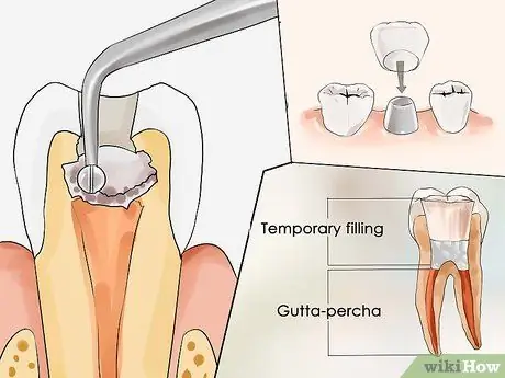 Tractar un abscés de les dents Pas 6