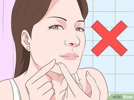 Get Rid of Acne Without Using Medication Step 30