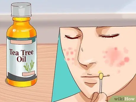 Get Rid of a Deep Pimple Step 13