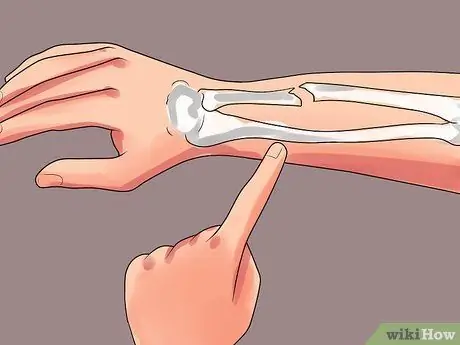 Nẹp gãy xương Humerus Bước 2