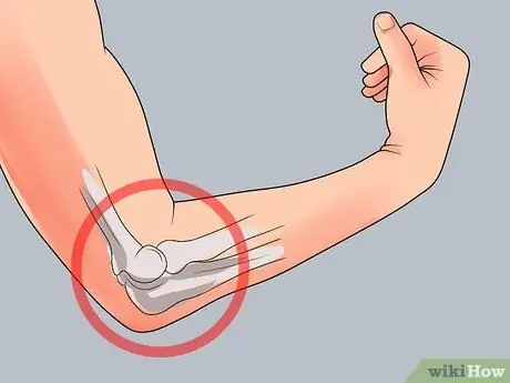 Splint a Humerus Fracture Step 3